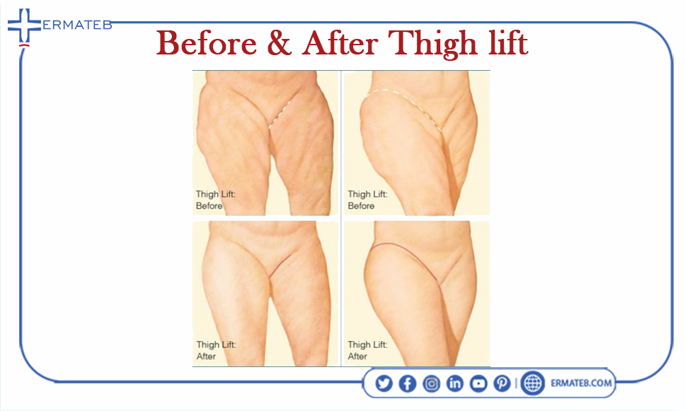 before and after thigh lift